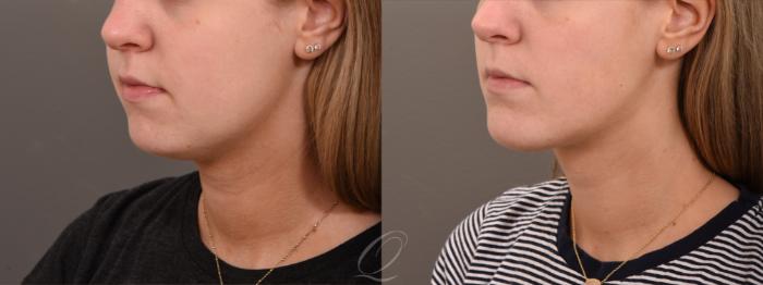 Buccal Fat Removal Case 1001738 Before & After Left Oblique | Serving Rochester, Syracuse & Buffalo, NY | Quatela Center for Plastic Surgery