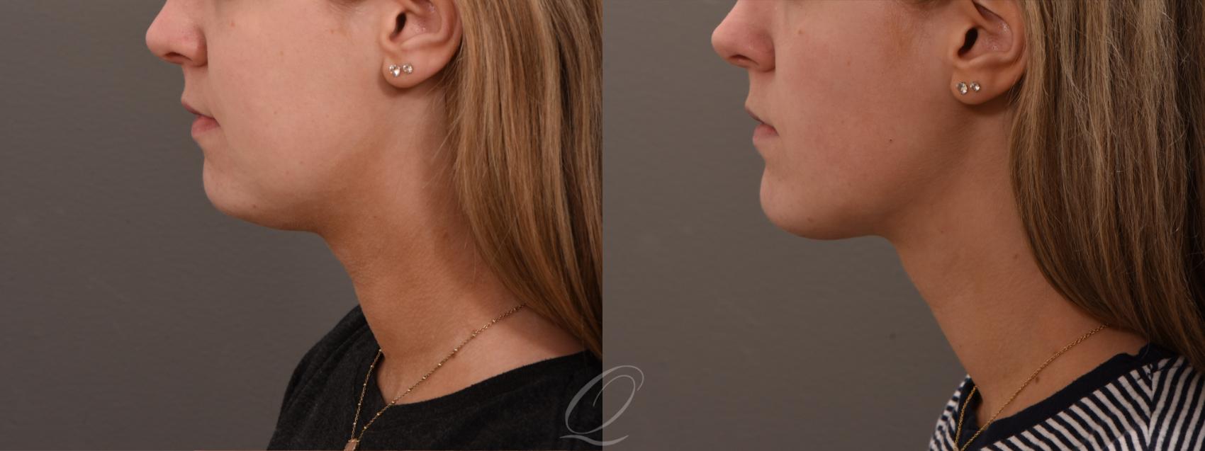 Deep Neck Contouring Case 1001738 Before & After Left Side | Serving Rochester, Syracuse & Buffalo, NY | Quatela Center for Plastic Surgery