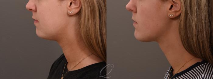 Buccal Fat Removal Case 1001738 Before & After Left Side | Serving Rochester, Syracuse & Buffalo, NY | Quatela Center for Plastic Surgery