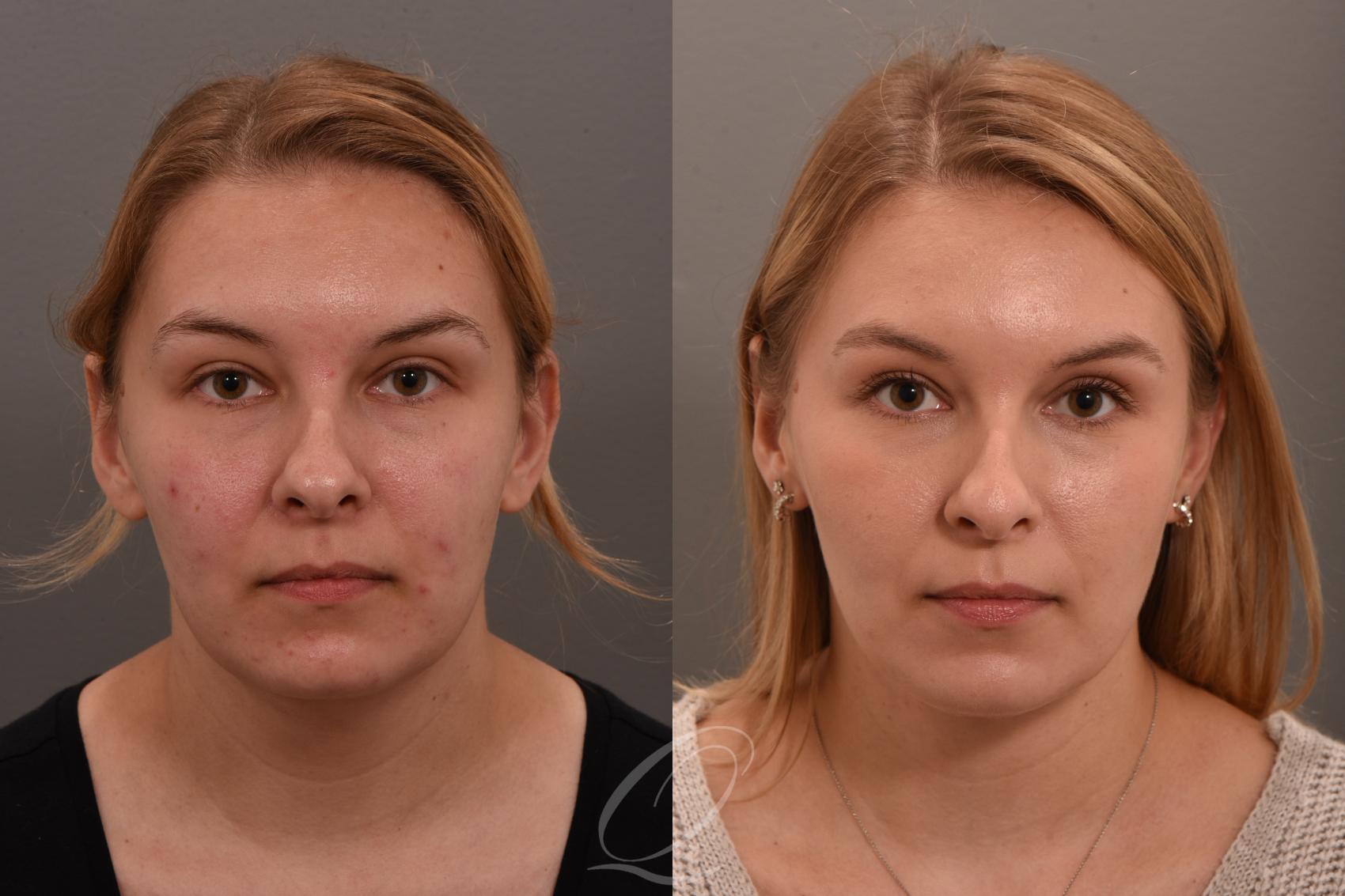 Deep Neck Contouring Case 1001747 Before & After Front | Serving Rochester, Syracuse & Buffalo, NY | Quatela Center for Plastic Surgery