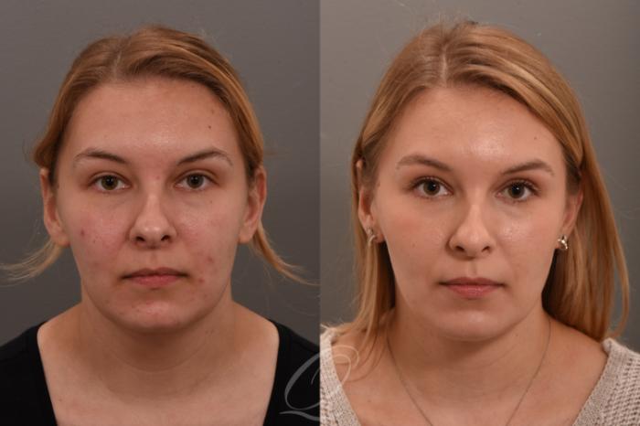 Deep Neck Contouring Case 1001747 Before & After Front | Serving Rochester, Syracuse & Buffalo, NY | Quatela Center for Plastic Surgery