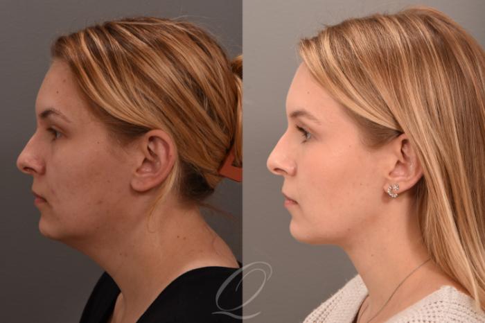 Deep Neck Contouring Case 1001747 Before & After Left Side | Serving Rochester, Syracuse & Buffalo, NY | Quatela Center for Plastic Surgery