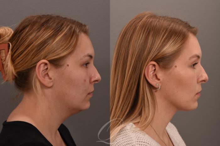 Deep Neck Contouring Case 1001747 Before & After Right Side | Serving Rochester, Syracuse & Buffalo, NY | Quatela Center for Plastic Surgery