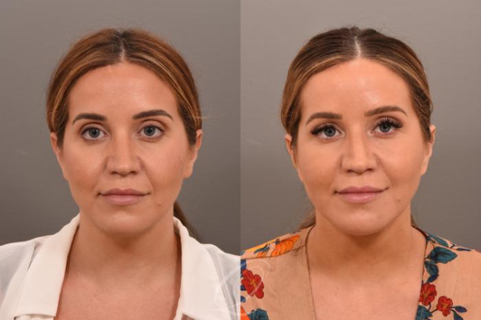 Deep Neck Contouring Case 1001750 Before & After Front | Serving Rochester, Syracuse & Buffalo, NY | Quatela Center for Plastic Surgery