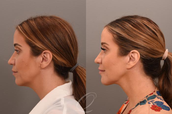 Deep Neck Contouring Case 1001750 Before & After Left Side | Serving Rochester, Syracuse & Buffalo, NY | Quatela Center for Plastic Surgery