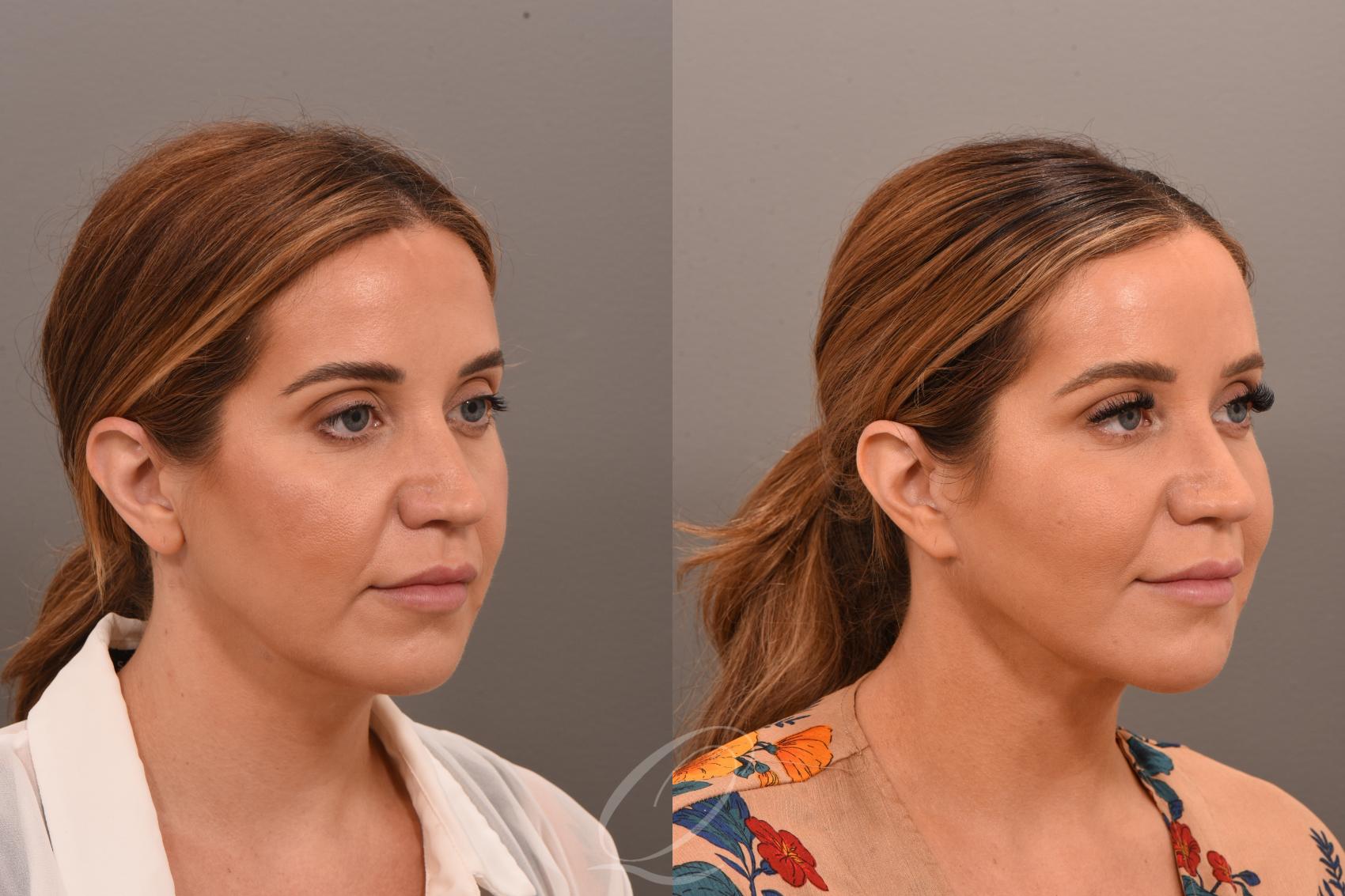 Mini-Facelift Case 1001750 Before & After Right Oblique | Serving Rochester, Syracuse & Buffalo, NY | Quatela Center for Plastic Surgery