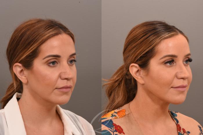 Deep Neck Contouring Case 1001750 Before & After Right Oblique | Serving Rochester, Syracuse & Buffalo, NY | Quatela Center for Plastic Surgery