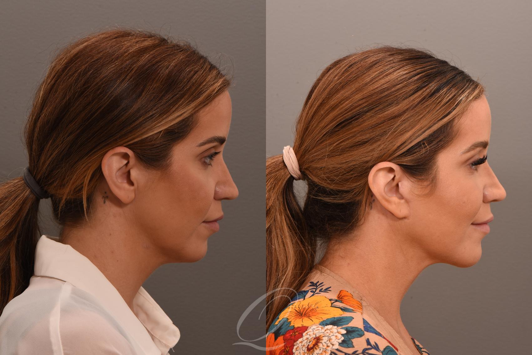 Mini-Facelift Case 1001750 Before & After Right Side | Serving Rochester, Syracuse & Buffalo, NY | Quatela Center for Plastic Surgery