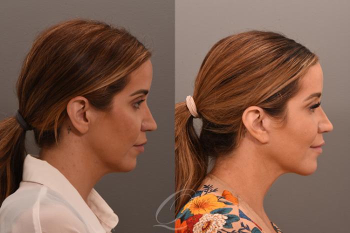 Deep Neck Contouring Case 1001750 Before & After Right Side | Serving Rochester, Syracuse & Buffalo, NY | Quatela Center for Plastic Surgery