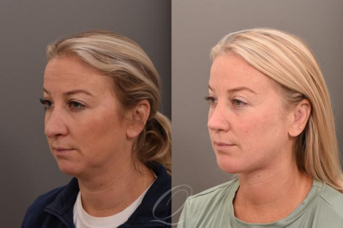 Deep Neck Contouring Case 1001752 Before & After Left Oblique | Serving Rochester, Syracuse & Buffalo, NY | Quatela Center for Plastic Surgery
