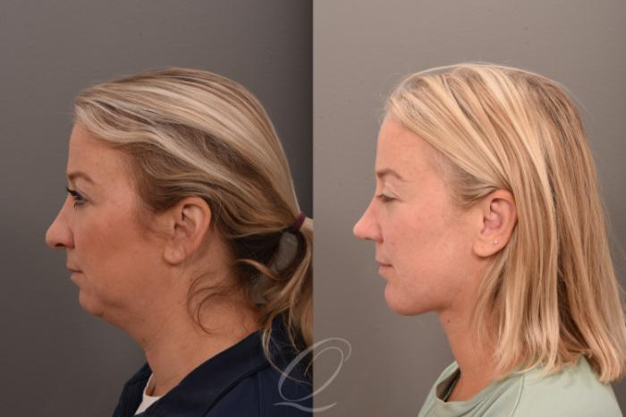 Deep Neck Contouring Case 1001752 Before & After Left Side | Serving Rochester, Syracuse & Buffalo, NY | Quatela Center for Plastic Surgery