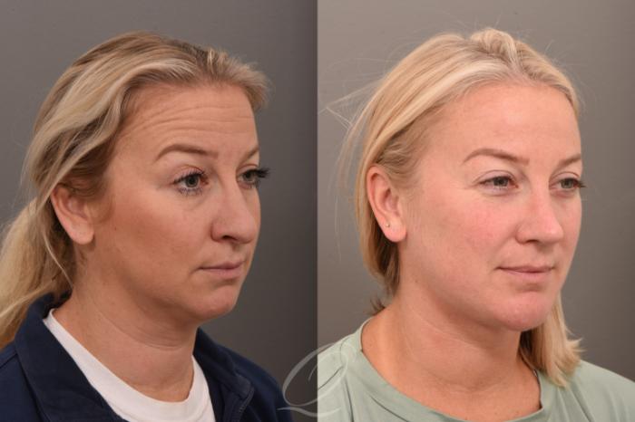 Deep Neck Contouring Case 1001752 Before & After Right Oblique | Serving Rochester, Syracuse & Buffalo, NY | Quatela Center for Plastic Surgery