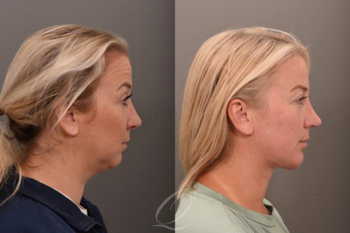 Deep Neck Contouring Case 1001752 Before & After Right Side | Serving Rochester, Syracuse & Buffalo, NY | Quatela Center for Plastic Surgery