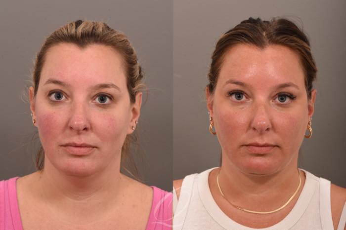 Deep Neck Contouring Case 1001753 Before & After Front | Serving Rochester, Syracuse & Buffalo, NY | Quatela Center for Plastic Surgery