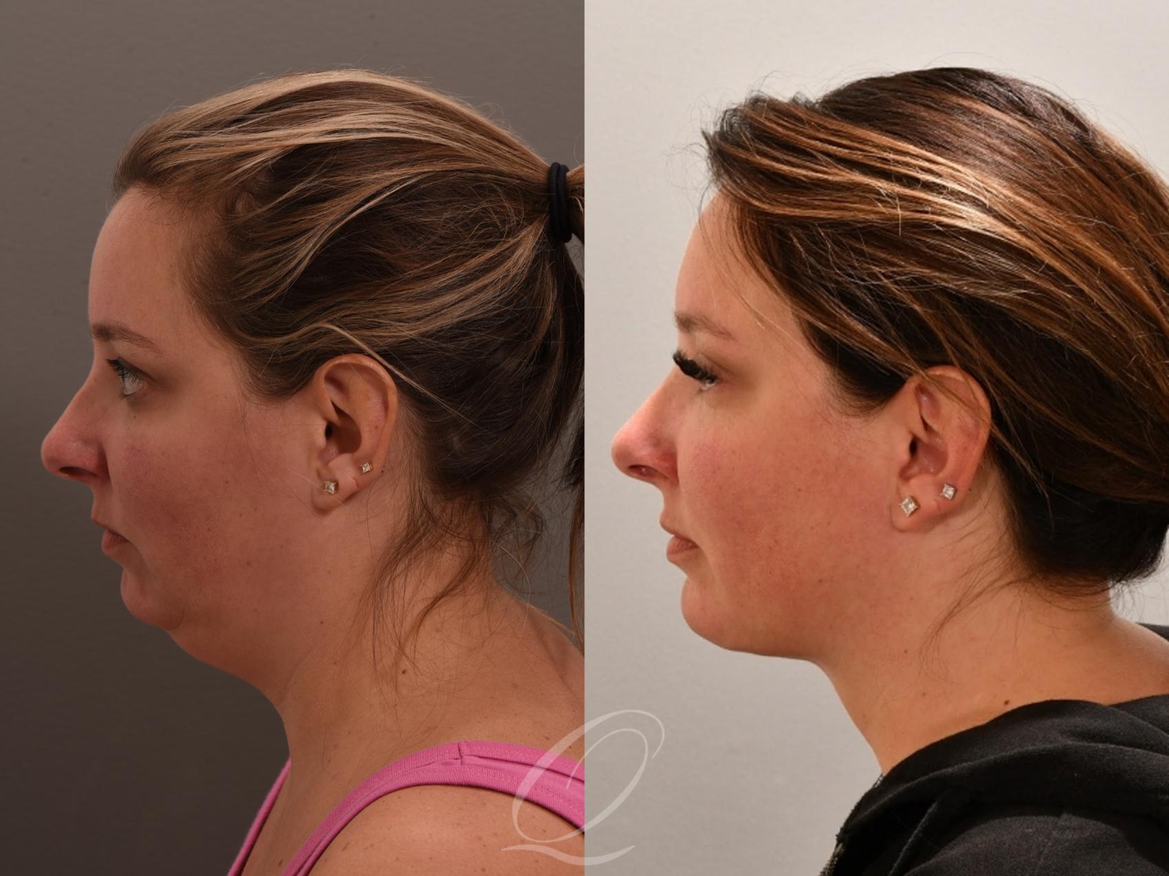 Deep Neck Contouring Case 1001753 Before & After Left Side | Serving Rochester, Syracuse & Buffalo, NY | Quatela Center for Plastic Surgery