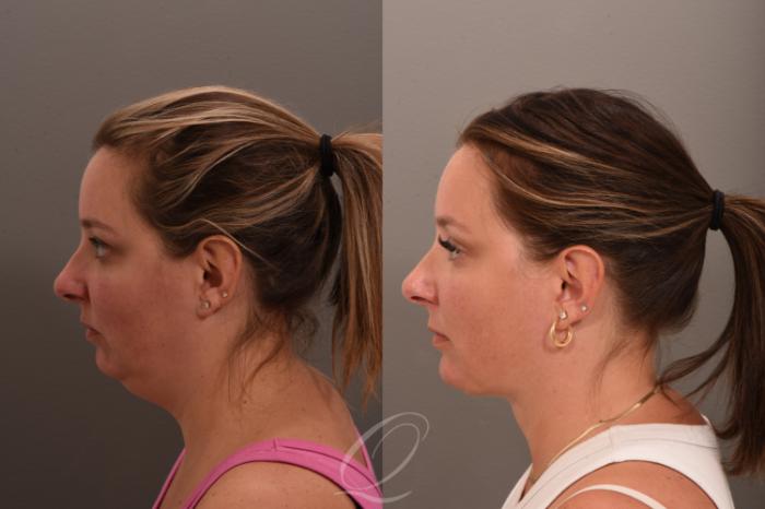 Deep Neck Contouring Case 1001753 Before & After Left Side | Serving Rochester, Syracuse & Buffalo, NY | Quatela Center for Plastic Surgery