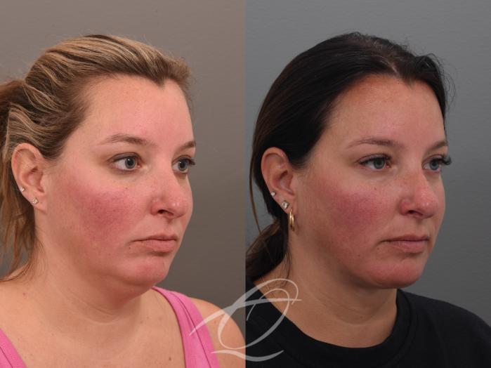 Deep Neck Contouring Case 1001753 Before & After Right Oblique | Serving Rochester, Syracuse & Buffalo, NY | Quatela Center for Plastic Surgery