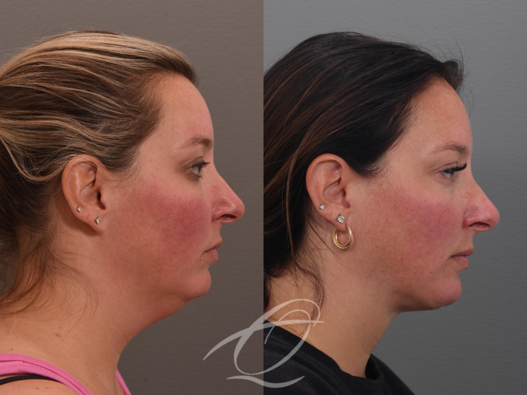 Deep Neck Contouring Case 1001753 Before & After Right Side | Serving Rochester, Syracuse & Buffalo, NY | Quatela Center for Plastic Surgery