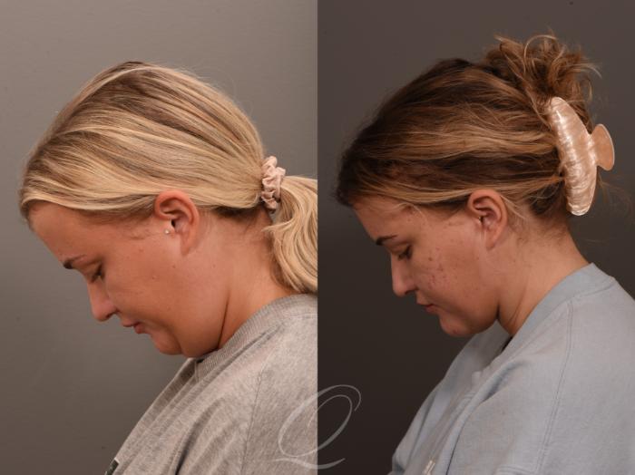 Deep Neck Contouring Case 1001798 Before & After Chin Down | Serving Rochester, Syracuse & Buffalo, NY | Quatela Center for Plastic Surgery