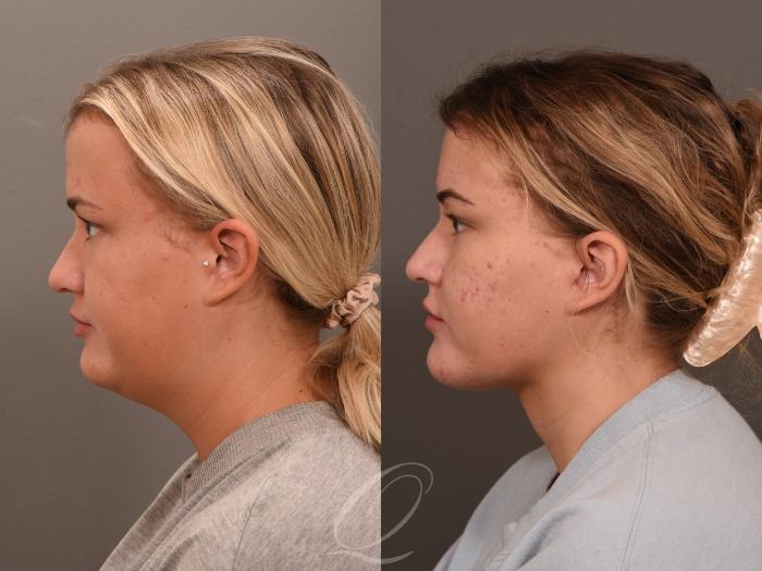 Deep Neck Contouring Case 1001798 Before & After Left Side | Serving Rochester, Syracuse & Buffalo, NY | Quatela Center for Plastic Surgery