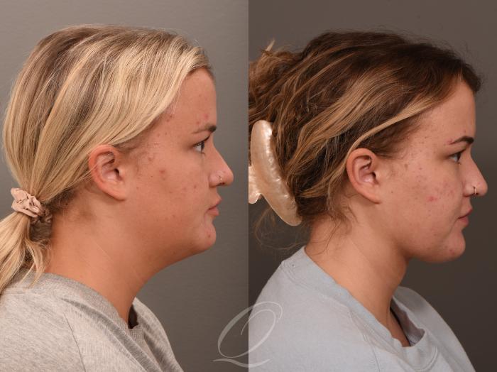 Deep Neck Contouring Case 1001798 Before & After Right Side | Serving Rochester, Syracuse & Buffalo, NY | Quatela Center for Plastic Surgery