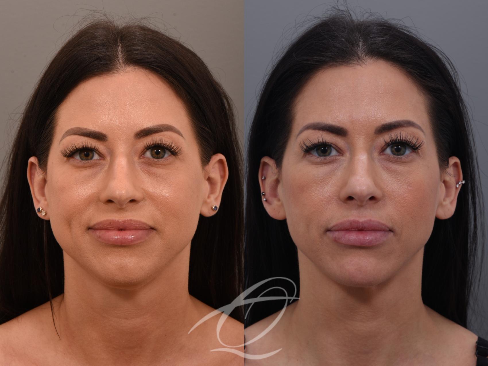 Deep Neck Contouring Case 1001876 Before & After Front | Serving Rochester, Syracuse & Buffalo, NY | Quatela Center for Plastic Surgery