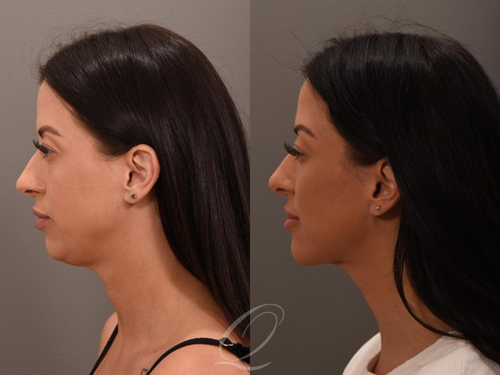 Deep Neck Contouring Case 1001876 Before & After Left Oblique | Serving Rochester, Syracuse & Buffalo, NY | Quatela Center for Plastic Surgery