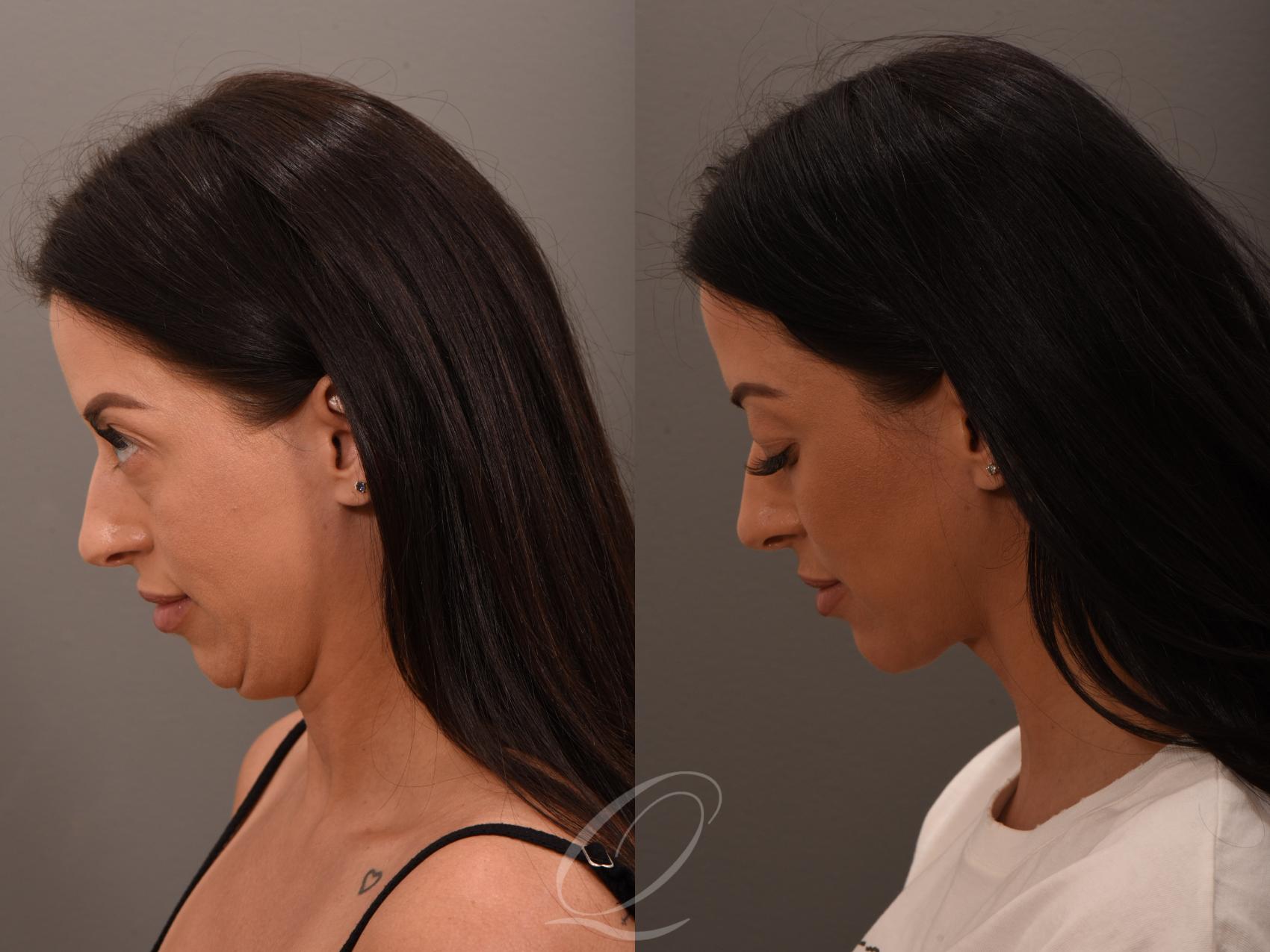 Deep Neck Contouring Case 1001876 Before & After Left Side | Serving Rochester, Syracuse & Buffalo, NY | Quatela Center for Plastic Surgery