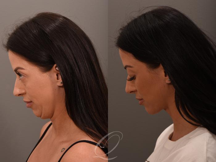Deep Neck Contouring Case 1001876 Before & After Left Side | Serving Rochester, Syracuse & Buffalo, NY | Quatela Center for Plastic Surgery