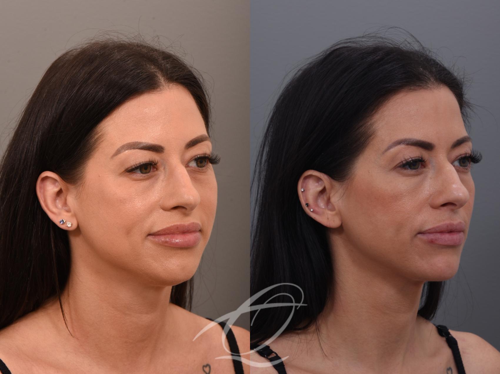 Deep Neck Contouring Case 1001876 Before & After Right Oblique | Serving Rochester, Syracuse & Buffalo, NY | Quatela Center for Plastic Surgery
