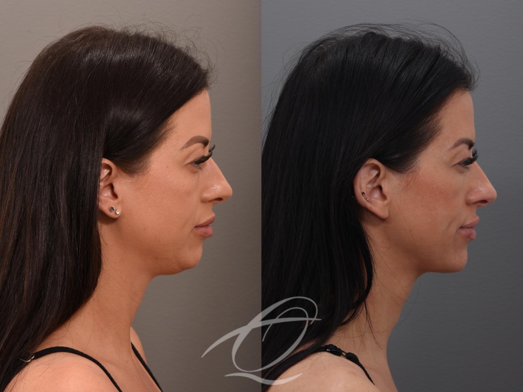Deep Neck Contouring Case 1001876 Before & After Right Side | Serving Rochester, Syracuse & Buffalo, NY | Quatela Center for Plastic Surgery