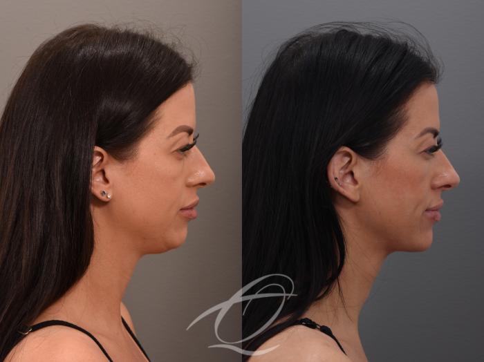 Deep Neck Contouring Case 1001876 Before & After Right Side | Serving Rochester, Syracuse & Buffalo, NY | Quatela Center for Plastic Surgery