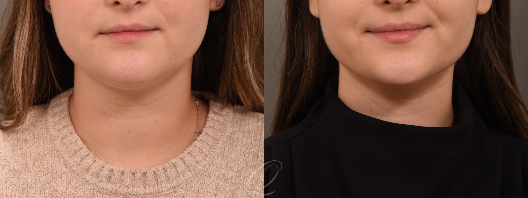 Deep Neck Contouring Case 1001929 Before & After Front | Serving Rochester, Syracuse & Buffalo, NY | Quatela Center for Plastic Surgery