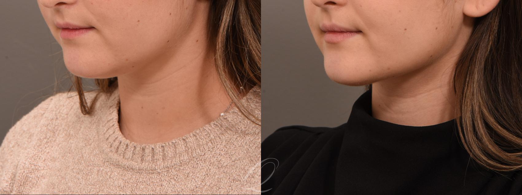 Deep Neck Contouring Case 1001929 Before & After Left Oblique | Serving Rochester, Syracuse & Buffalo, NY | Quatela Center for Plastic Surgery