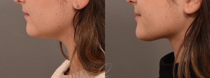 Deep Neck Contouring Case 1001929 Before & After Left Side | Serving Rochester, Syracuse & Buffalo, NY | Quatela Center for Plastic Surgery