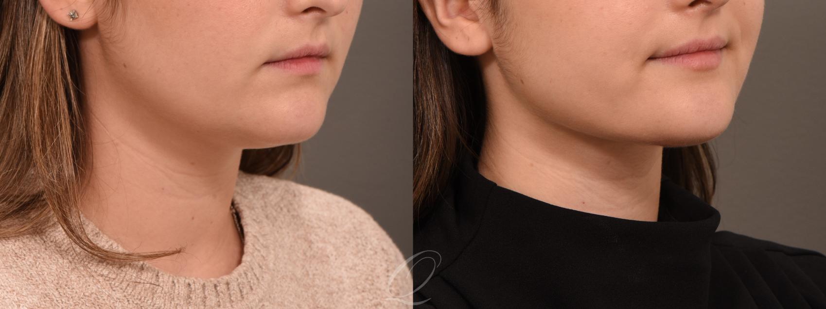 Deep Neck Contouring Case 1001929 Before & After Right Oblique | Serving Rochester, Syracuse & Buffalo, NY | Quatela Center for Plastic Surgery