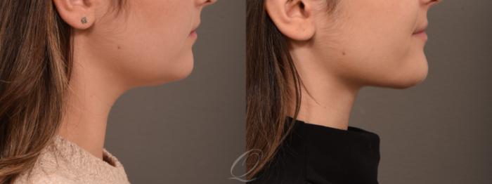 Deep Neck Contouring Case 1001929 Before & After Right Side | Serving Rochester, Syracuse & Buffalo, NY | Quatela Center for Plastic Surgery