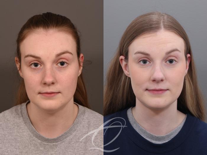 Deep Neck Contouring Case 1001930 Before & After Front | Serving Rochester, Syracuse & Buffalo, NY | Quatela Center for Plastic Surgery