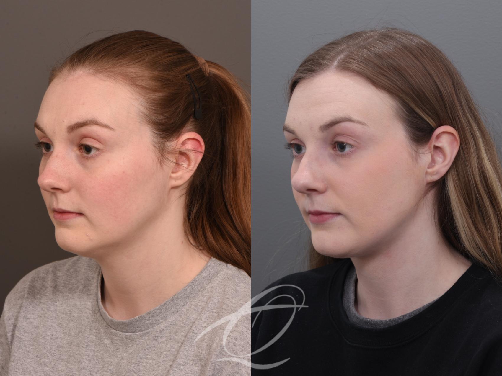 Deep Neck Contouring Case 1001930 Before & After Left Oblique | Serving Rochester, Syracuse & Buffalo, NY | Quatela Center for Plastic Surgery