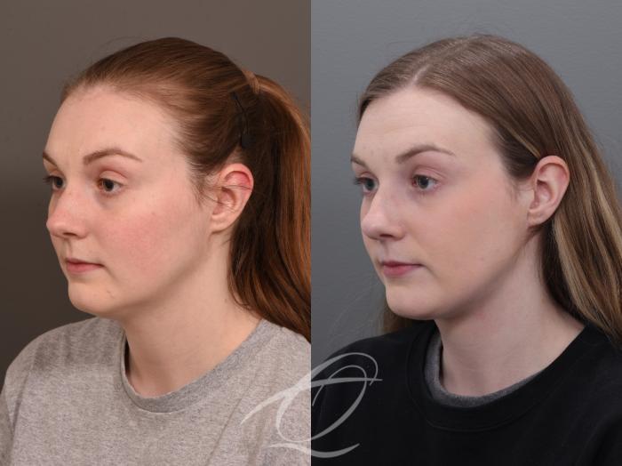 Deep Neck Contouring Case 1001930 Before & After Left Oblique | Serving Rochester, Syracuse & Buffalo, NY | Quatela Center for Plastic Surgery