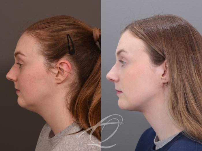 Deep Neck Contouring Case 1001930 Before & After Left Side | Serving Rochester, Syracuse & Buffalo, NY | Quatela Center for Plastic Surgery
