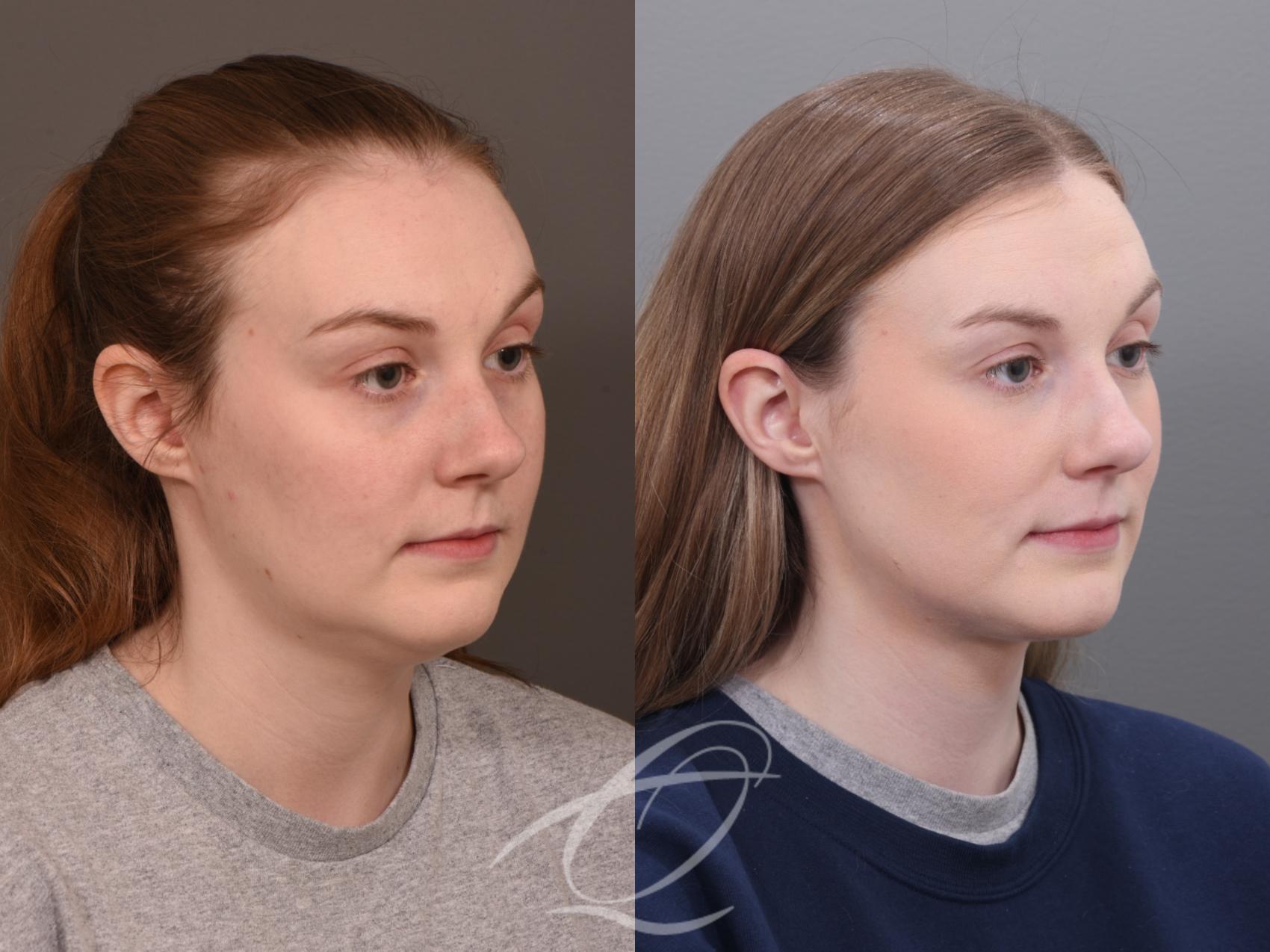 Deep Neck Contouring Case 1001930 Before & After Right Oblique | Serving Rochester, Syracuse & Buffalo, NY | Quatela Center for Plastic Surgery