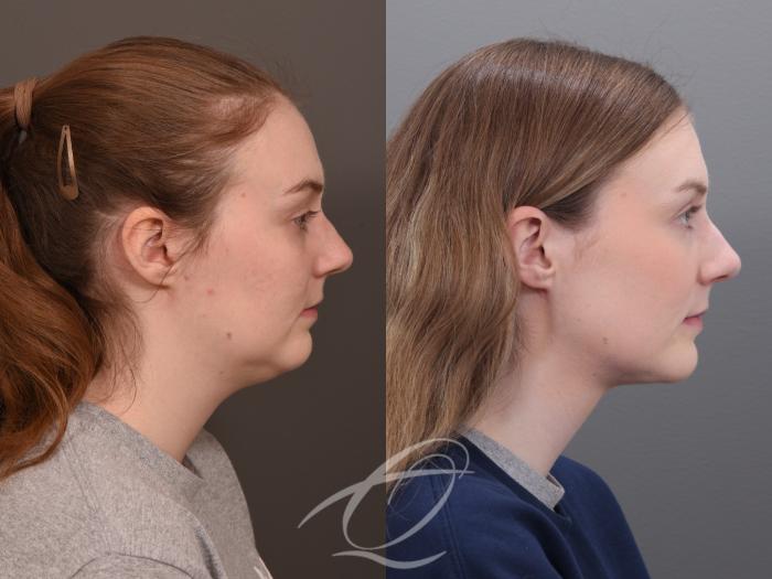 Deep Neck Contouring Case 1001930 Before & After Right Side | Serving Rochester, Syracuse & Buffalo, NY | Quatela Center for Plastic Surgery