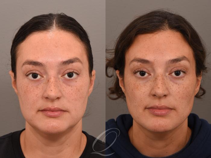 Deep Neck Contouring Case 1001963 Before & After Front | Serving Rochester, Syracuse & Buffalo, NY | Quatela Center for Plastic Surgery