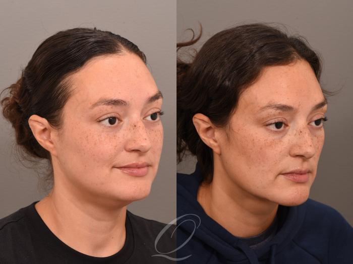 Deep Neck Contouring Case 1001963 Before & After Left Oblique | Serving Rochester, Syracuse & Buffalo, NY | Quatela Center for Plastic Surgery