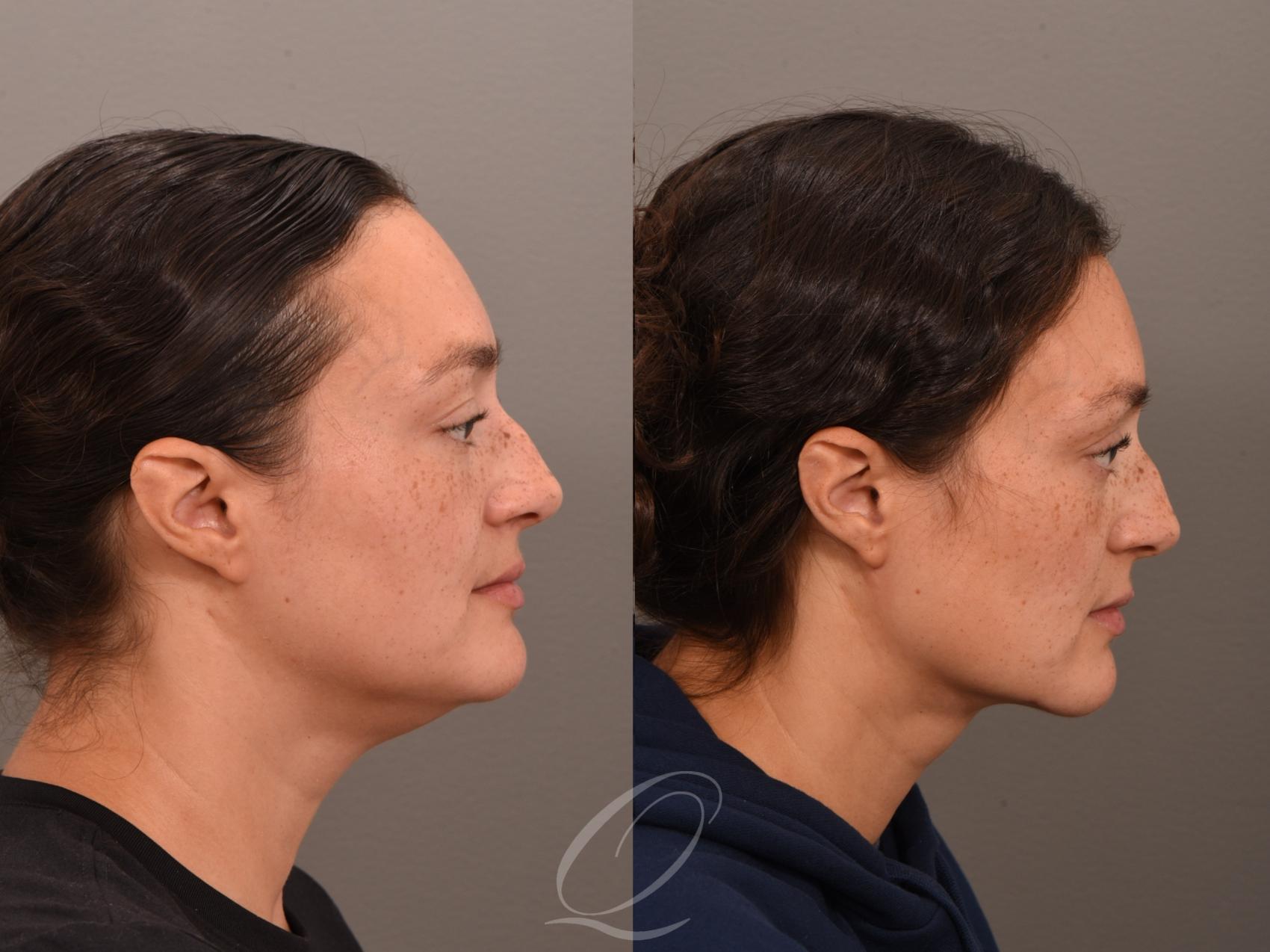 Deep Neck Contouring Case 1001963 Before & After Left Side | Serving Rochester, Syracuse & Buffalo, NY | Quatela Center for Plastic Surgery