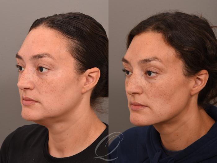 Deep Neck Contouring Case 1001963 Before & After Right Oblique | Serving Rochester, Syracuse & Buffalo, NY | Quatela Center for Plastic Surgery