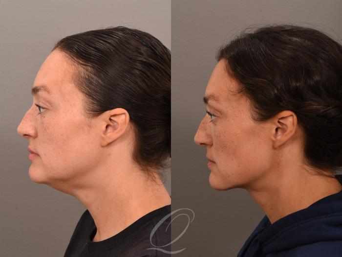 Deep Neck Contouring Case 1001963 Before & After Right Side | Serving Rochester, Syracuse & Buffalo, NY | Quatela Center for Plastic Surgery