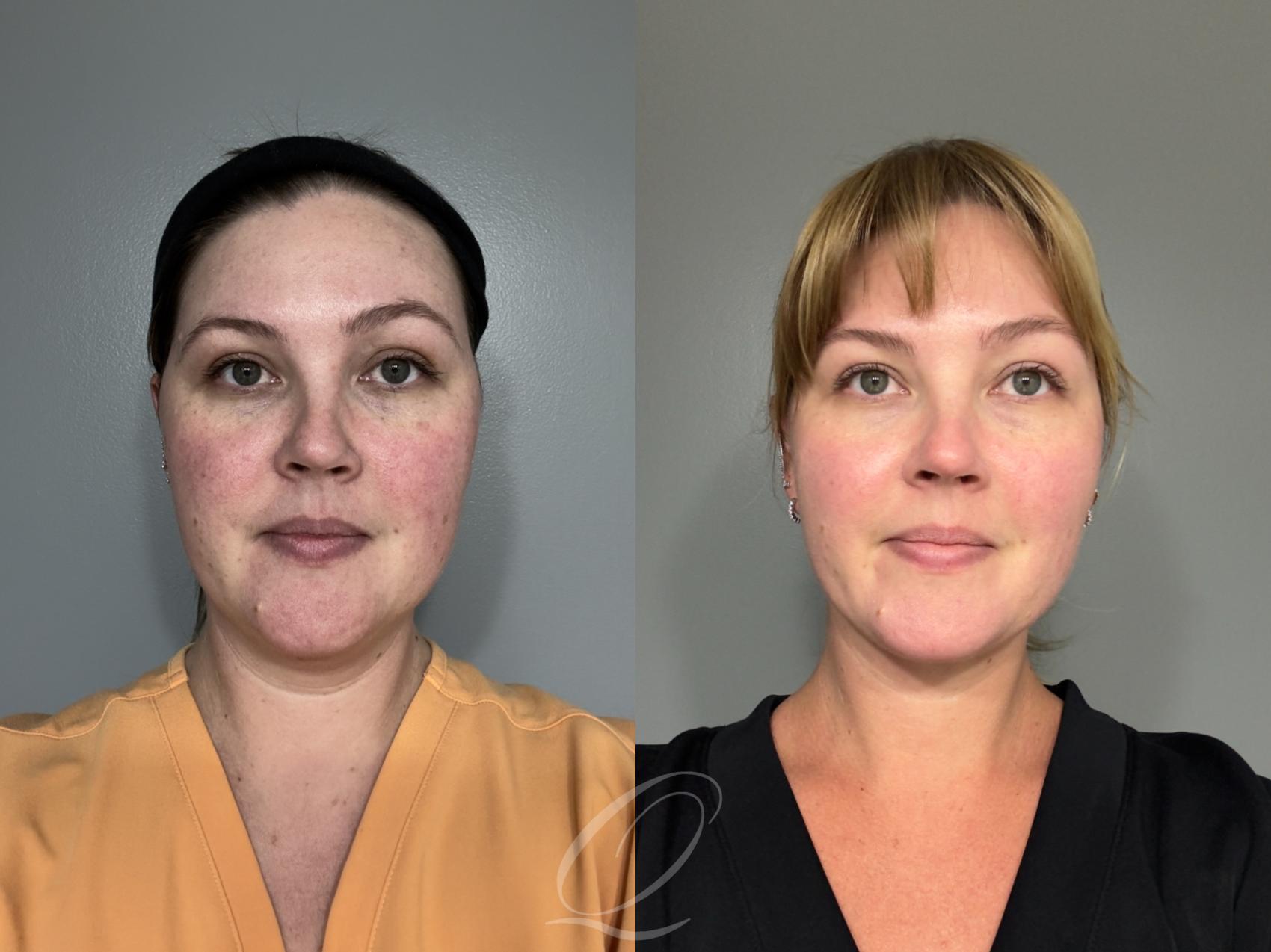 Deep Neck Contouring Case 1001992 Before & After Front | Serving Rochester, Syracuse & Buffalo, NY | Quatela Center for Plastic Surgery
