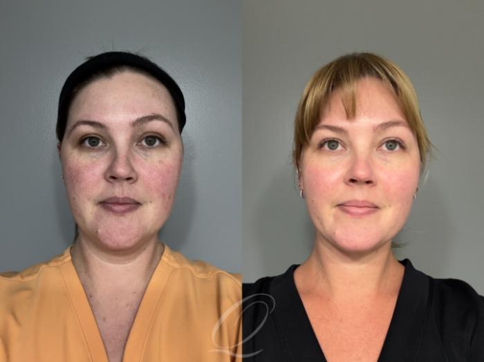 Deep Neck Contouring Case 1001992 Before & After Front | Serving Rochester, Syracuse & Buffalo, NY | Quatela Center for Plastic Surgery